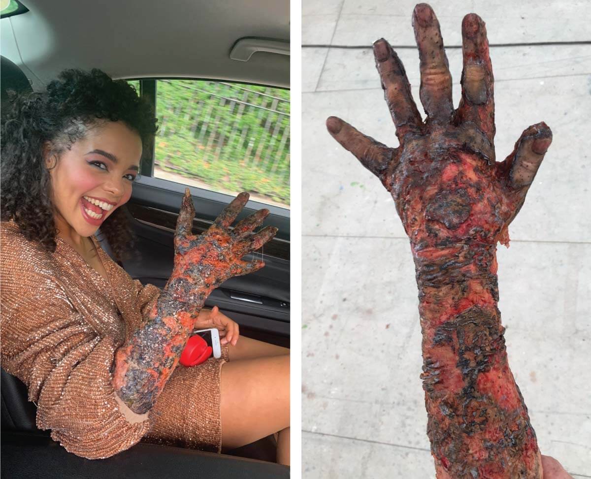 Lydia West enjoying her freshly burned arm appliance.